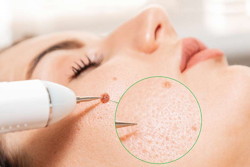 mole-removal-at-hang-spa